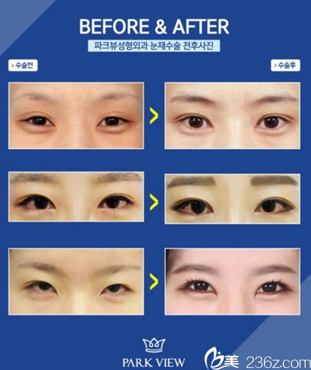 韓國(guó)Parkview整形外科雙眼皮案例 韓國(guó)Parkview整形外科雙眼皮案例