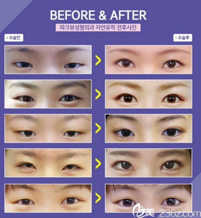 韓國(guó)Parkview整形外科做雙眼皮好嗎