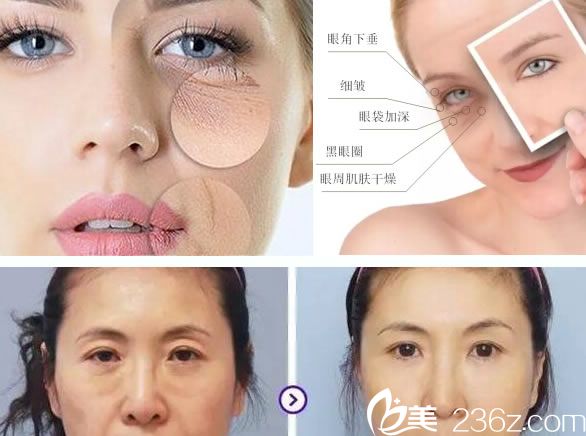 眼周抗衰案例 眼周抗衰案例