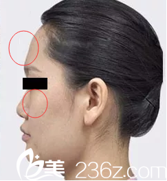 干癟的蘋果肌和額頭