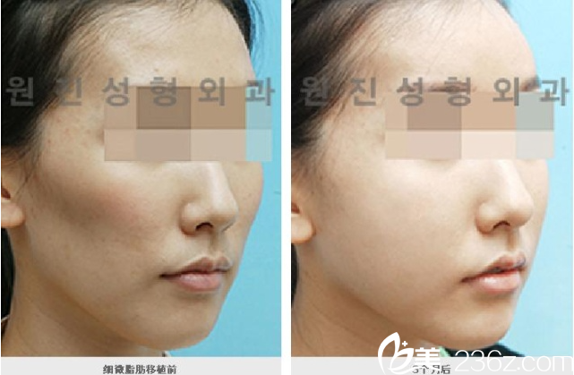 韓國原辰醫(yī)院面部自體脂肪填充案例