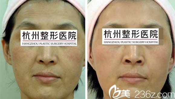 注射除皺效果 注射除皺效果