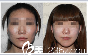 北京圣嘉新張笑天醫(yī)生改臉型案例