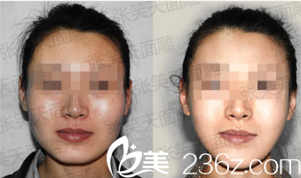 北京圣嘉新張笑天面部輪廓整形案例