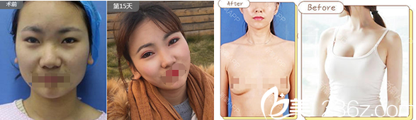 合肥壹加壹甘泉涌雙眼皮+豐胸案例 合肥壹加壹甘泉涌雙眼皮+豐胸案例