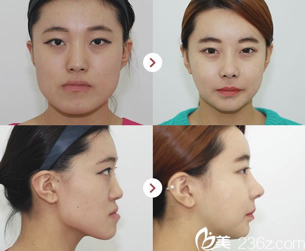 韓國姜永浩院長雙鄂手術(shù)案例 韓國姜永浩院長雙鄂手術(shù)案例