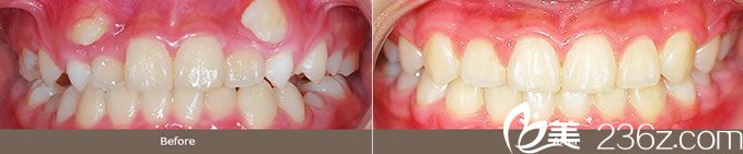 金允宣院長(zhǎng)虎牙矯正案例 金允宣院長(zhǎng)虎牙矯正案例