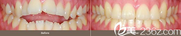 全輝院長(zhǎng)開(kāi)放式咬合牙齒矯正案例