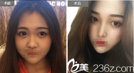 蘇州紫馨邵剛玻尿酸隆鼻案例 蘇州紫馨邵剛玻尿酸隆鼻案例