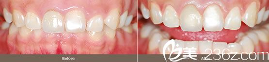 羅英民院長(zhǎng)的牙床整形案例 羅英民院長(zhǎng)的牙床整形案例