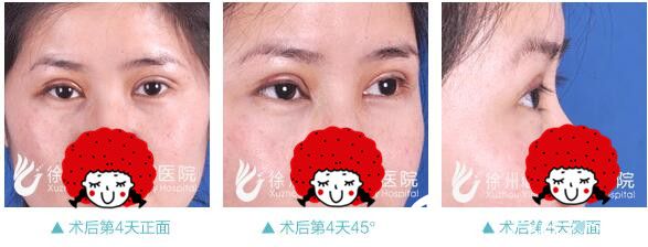 雙眼皮術(shù)后第四天恢復(fù) 雙眼皮術(shù)后第四天恢復(fù)