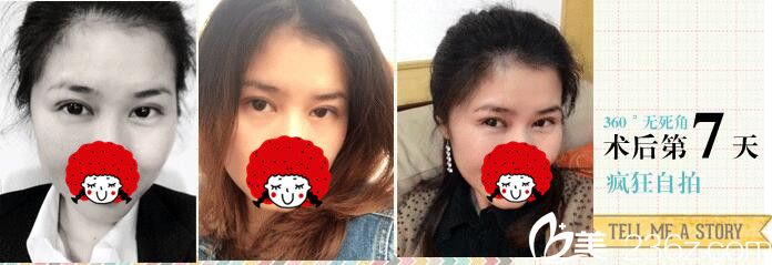 徐州心源雙眼皮+上瞼下垂矯正案例6980元效果好嗎