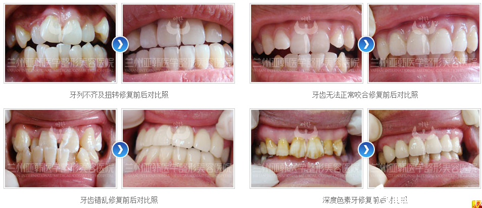 蘭州亞韓李偉醫(yī)生口腔修復案例 蘭州亞韓李偉醫(yī)生口腔修復案例