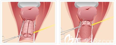 尹虎珠博士陰道縮陰手術(shù)與傳統(tǒng)的陰道緊縮術(shù)區(qū)別 尹虎珠博士陰道縮陰手術(shù)與傳統(tǒng)的陰道緊縮術(shù)區(qū)別