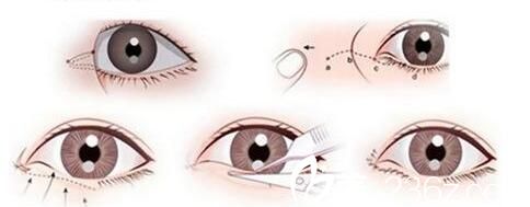 20171213_1513137664226739.jpg 開內(nèi)眼角.jpg