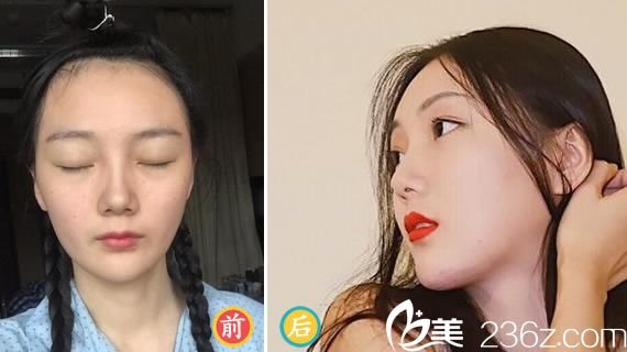 杭州唐冬生醫(yī)生下頜角整形案例 杭州唐冬生醫(yī)生下頜角整形案例