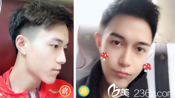 唐冬生醫(yī)生做顴骨降低案例 唐冬生醫(yī)生做顴骨降低案例