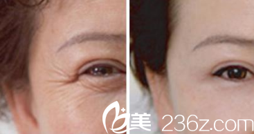 韓國(guó)現(xiàn)代美學(xué)整形醫(yī)院案例 韓國(guó)現(xiàn)代美學(xué)整形醫(yī)院案例