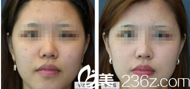 韓國(guó)現(xiàn)代美學(xué)整形醫(yī)院案例 韓國(guó)現(xiàn)代美學(xué)整形醫(yī)院案例