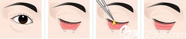 韓國Topclass整形外科金柱淵去眼袋 韓國Topclass整形外科金柱淵去眼袋