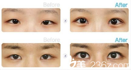 安徽韓美劉冷雙眼皮案例對比照片