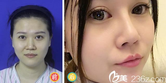 杭州愛琴海沈劍隆鼻案例 杭州愛琴海沈劍隆鼻案例