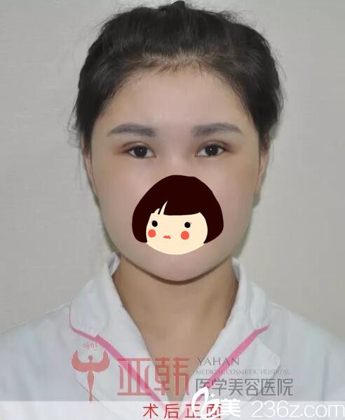 埋線雙眼皮術(shù)后即刻效果 埋線雙眼皮術(shù)后即刻效果