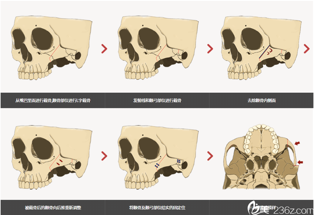 韓國齊娥牙科顴骨手術(shù)示意圖 韓國齊娥牙科顴骨手術(shù)示意圖
