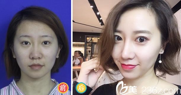 楊甄宇的鼻綜合整形案例 楊甄宇的鼻綜合整形案例