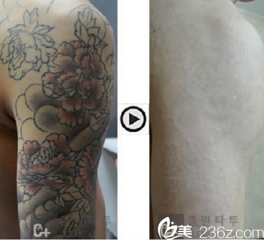 樸在雄 院長洗紋身案例 樸在雄 院長洗紋身案例