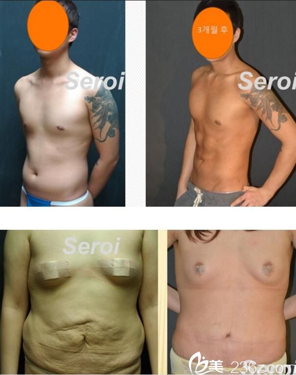 羅鈺周吸脂案例 羅鈺周吸脂案例