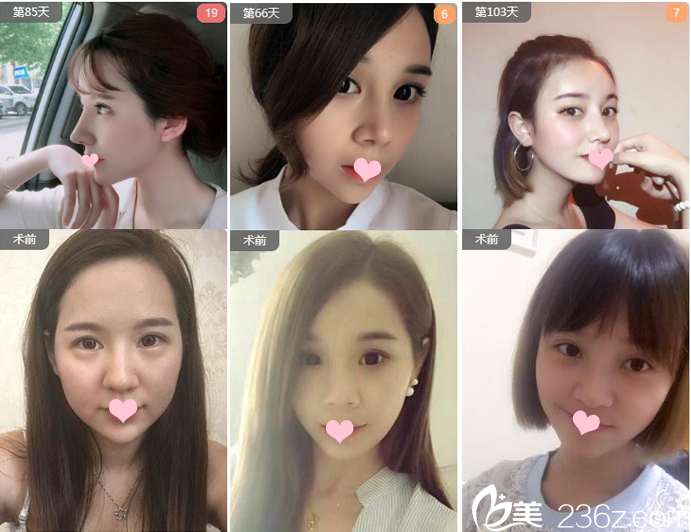 廣州藝美整形醫(yī)院李闖院長隆鼻案例 廣州藝美整形醫(yī)院李闖院長隆鼻案例