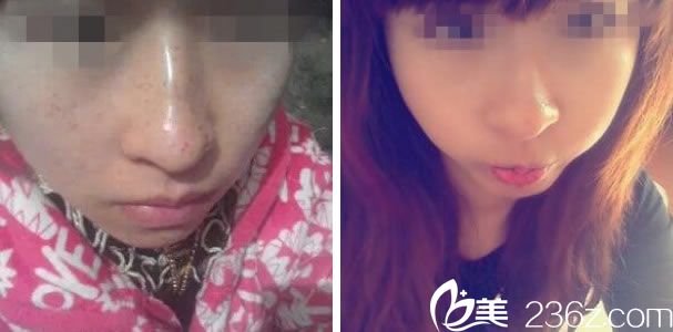 俞錫娟祛斑案例 俞錫娟祛斑案例