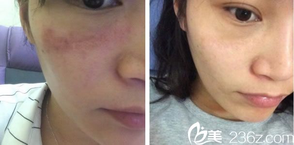 俞錫娟醫(yī)生的祛疤痕案例效果 俞錫娟醫(yī)生的祛疤痕案例效果