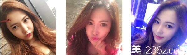 我在韓國Topclass整形外科花26000元眼型矯正+開外眼角，金行準院長真人案例