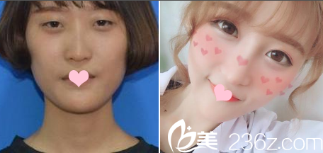 廣州藝美李闖割雙眼皮案例