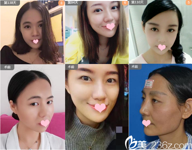 廣州藝美整形醫(yī)院張濤主任雙眼皮案例 廣州藝美整形醫(yī)院張濤主任雙眼皮案例