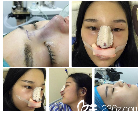 廣州藝美李闖鼻修復(fù)即刻效果 廣州藝美李闖鼻修復(fù)即刻效果