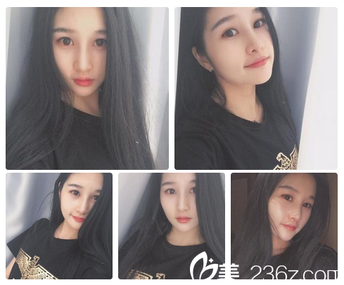 找李闖院長做鼻修復(fù)1個月恢復(fù)情況 找李闖院長做鼻修復(fù)1個月恢復(fù)情況