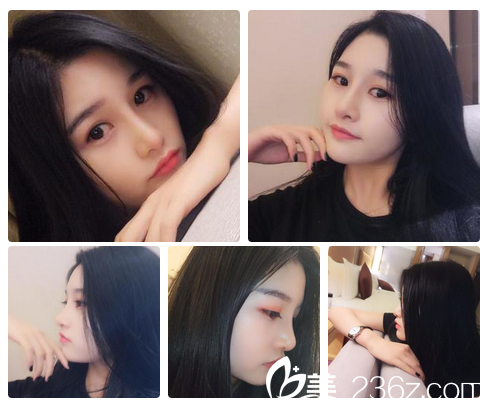 膨體隆鼻失敗修復(fù)1個半月自拍 膨體隆鼻失敗修復(fù)1個半月自拍