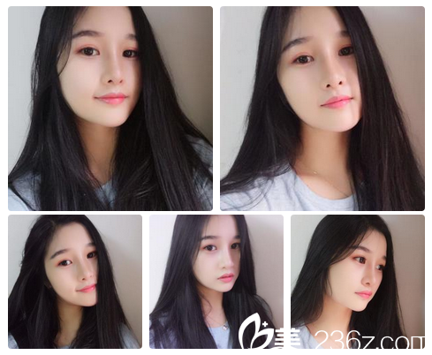 廣州藝美李闖鼻修復(fù)3個月照片 廣州藝美李闖鼻修復(fù)3個月照片