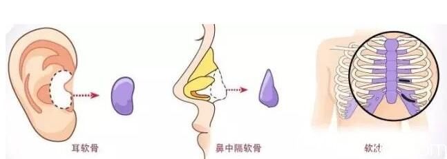 韓國VIP整形外科自體組織鼻整形 韓國VIP整形外科自體組織鼻整形