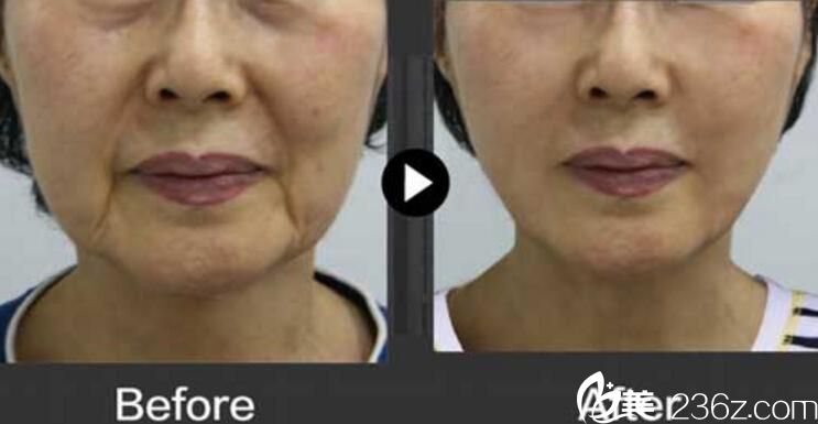 韓國(guó)德社羅伊整形外科樸明旭院長(zhǎng)面部提升案例