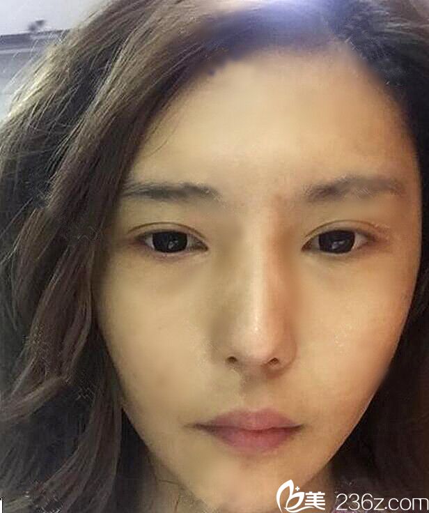 THESEROI(韓國(guó)德社羅伊整形外科)樸明旭院長(zhǎng)面部提升效果怎么樣？三重埋線提升多少錢(qián)？真人案例