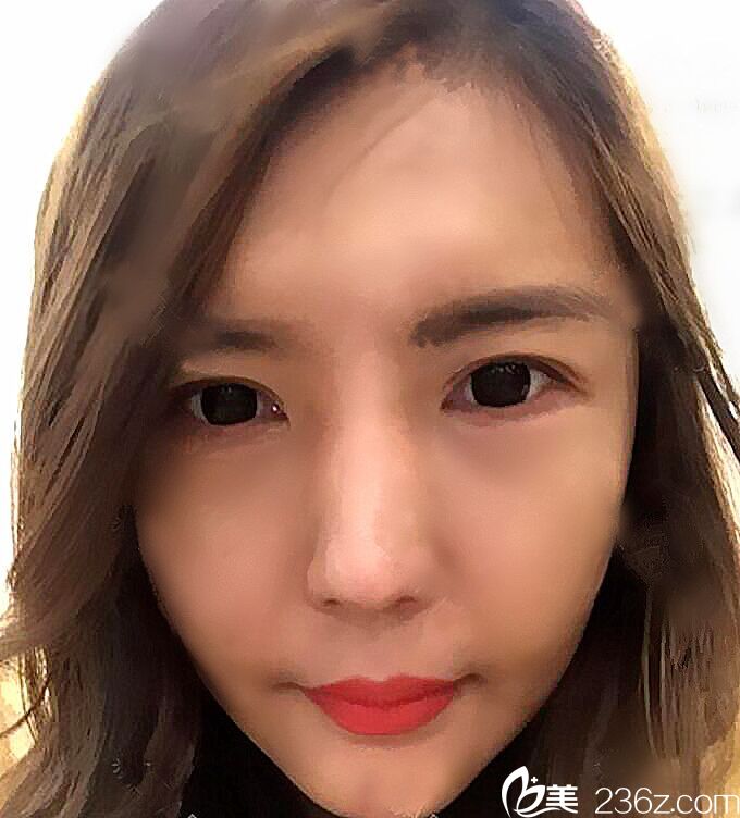 韓國(guó)德社羅伊整形外科樸明旭院長(zhǎng)埋線提升真人案例