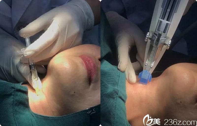 嗨體去頸紋過程