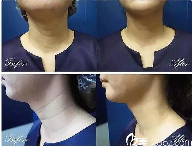 嗨體注射除皺術后即刻效果