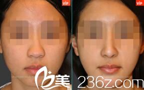  韓國(guó)VIP整形外科朝天鼻矯正