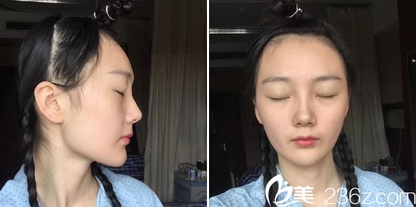 在<!--<i data=20240703-sp></i>-->做下頜角前