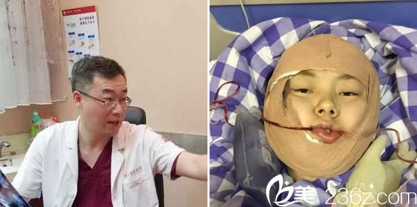 下頜角手術(shù)完成當(dāng)天照片